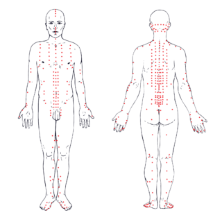 Pop-art style diagram of a man’s body, used for acupuncture.