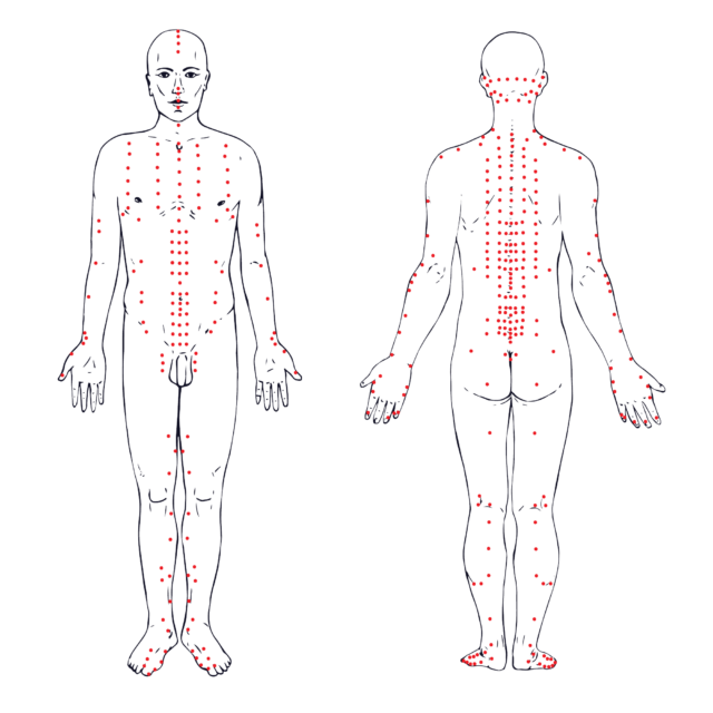 Pop-art style diagram of a man’s body, used for acupuncture.